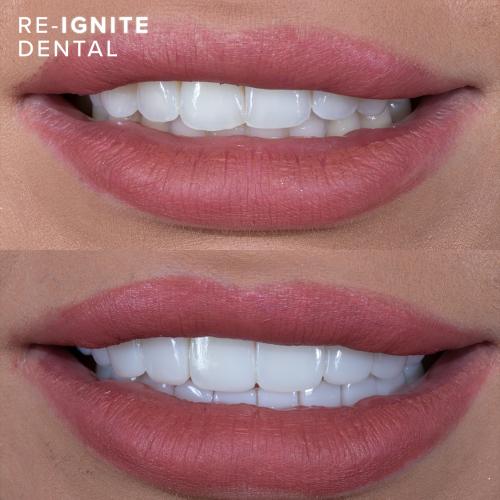 Durable and Longlasting <b>Composite Bonding</b> in Hale Manchester