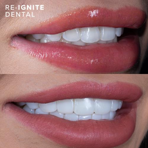 Durable and Longlasting <b>Composite Bonding</b> in Hale Manchester