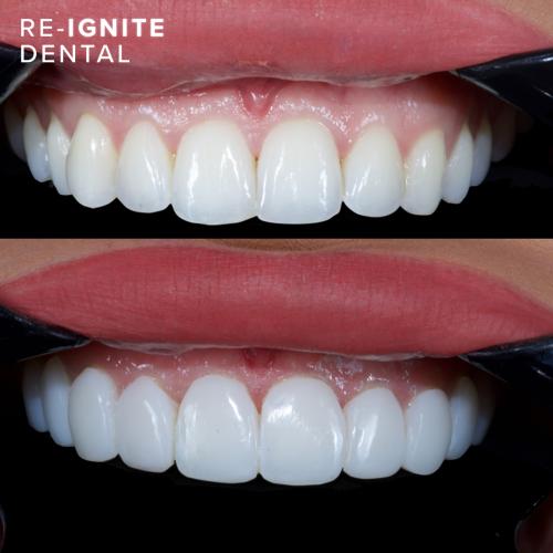 Composite Bonding