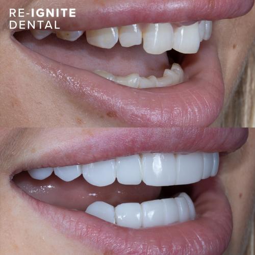 Durable and Longlasting <b>Composite Bonding</b> in Hale Manchester