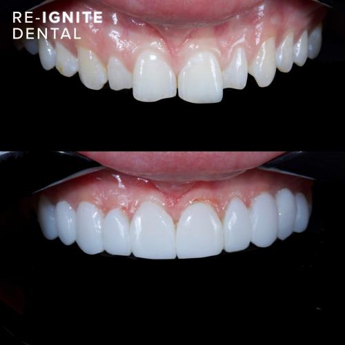 Durable and Longlasting <b>Composite Bonding</b> in Hale Manchester