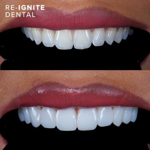 Durable and Longlasting <b>Composite Bonding</b> in Hale Manchester