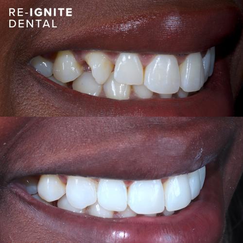 <b>Teeth Whitening</b> In Hale & Hale Barns Altrincham