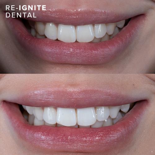 <b>Teeth Whitening</b> In Hale & Hale Barns Altrincham