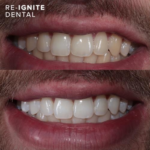 <b>Teeth Whitening</b> In Hale & Hale Barns Altrincham