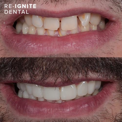 Invisalign Manchester