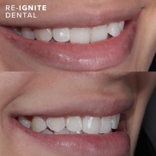 Invisalign Manchester