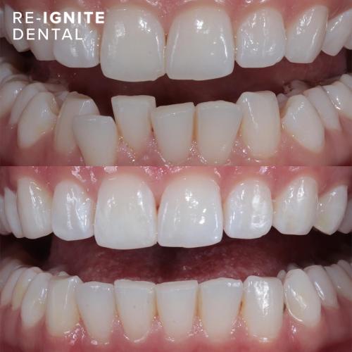 Invisalign Manchester