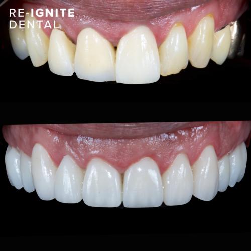 Smile-Enhancing <b>Porcelain Veneers</b> in Hale & Hale Barns Altrincham