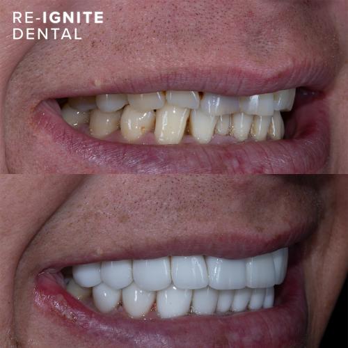 Smile-Enhancing <b>Porcelain Veneers</b> in Hale & Hale Barns Altrincham