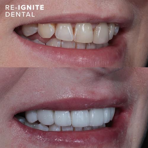 Smile-Enhancing <b>Porcelain Veneers</b> in Hale & Hale Barns Altrincham