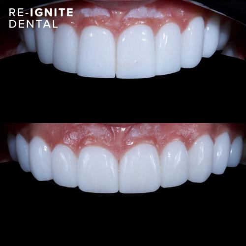 Smile-Enhancing <b>Porcelain Veneers</b> in Hale & Hale Barns Altrincham