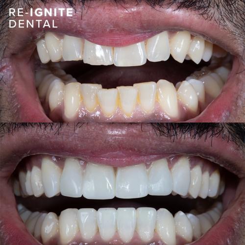 Invisalign Manchester