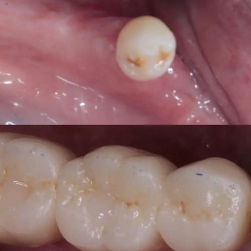 Smile-Making <b>Dental Implants </b>Manchester
