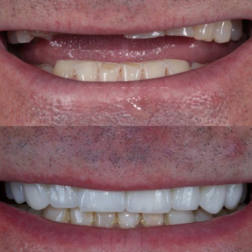 Dental Implants Manchester