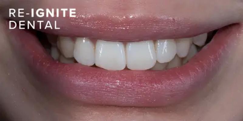 <b>Teeth Whitening</b> In Hale & Hale Barns Altrincham
