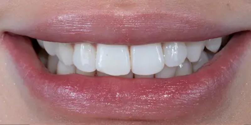 <b>Teeth Whitening</b> In Hale & Hale Barns Altrincham