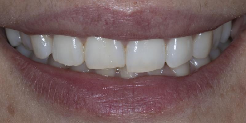 <b>Teeth Whitening</b> In Hale & Hale Barns Altrincham