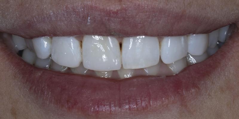 <b>Teeth Whitening</b> In Hale & Hale Barns Altrincham
