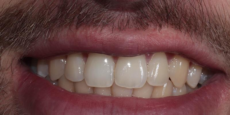 <b>Teeth Whitening</b> In Hale & Hale Barns Altrincham