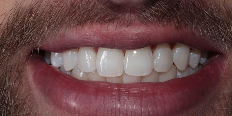 <b>Teeth Whitening</b> In Hale & Hale Barns Altrincham